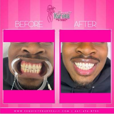 Teeth Whitening